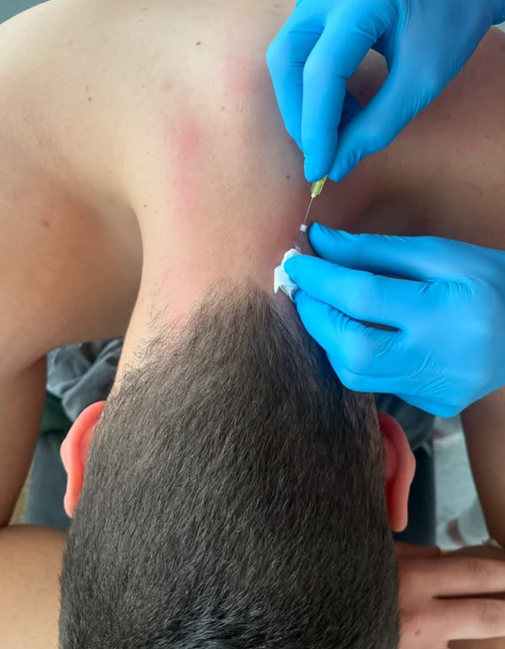 Aplikácia biodermálnych nití v oblasti krku